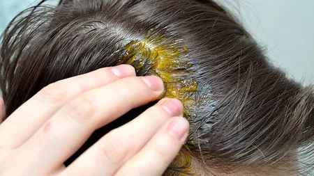 Îi cădea părul şi încercase tot felul de tratamente. Şi-a pus în fiecare săptămână scorţişoară în cap. Cum arată după un an