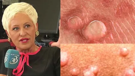 Lidia Fecioru oferă leacul săptămânii: Cum poți trata chisturile ovariene şi fibromatoza uterină