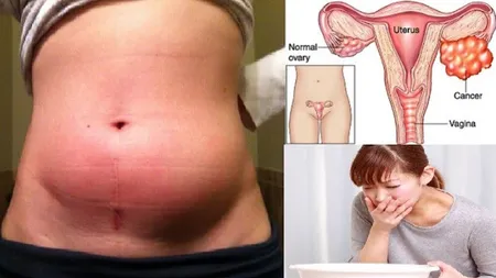 Ucigaşul silenţios: Simptomele teribile ale cancerului la stomac