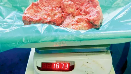 A fost extirpată cea mai mare tumoră pe creier. Medicii au extras cu succes formaţiunea tumorală de 1,87 kilograme