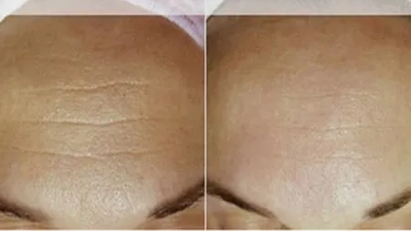 Cum scapi de riduri în şapte zile. Reţeta asta face minuni