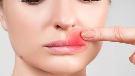 Adevărat sau fals despre herpes
