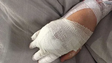 Femeia care a fost mâncată de vie de o bacterie! Cum a ajuns să arate de la o banală mâncărime! FOTO