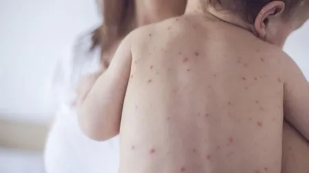 Sorina Pintea: Nu mai putem aştepta, vom demara o campanie de vaccinare door to door împotriva rujeolei