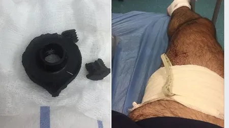 S-a ales cu o gaură în picior de la o grenadă a Jandarmeriei, iar acum a primit o nouă LOVITURĂ. Cu ce diagnostic a ieşit din SPITAL