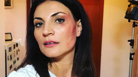 Ioana Ginghină, cu faţa tumefiată, la câteva zile după ce a vorbit despre divorţ: 