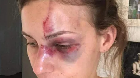Un sportiv celebru şi-a desfigurat iubita în BĂTAIE. Motivul este ŞOCANT