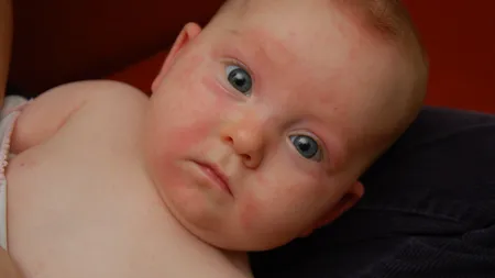 Urticarie la copii. Ce este. De ce apare şi cum se tratează urticaria la copii