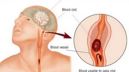 Stresul poate provoca un accident vascular cerebral. Care sunt simptomele unui AVC