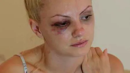 Alexandra Stan, desfigurată! Dezvăluiri-şoc despre bătaia încasată acum şase ani