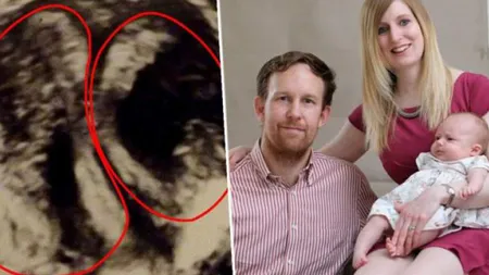 O femeie cu două vagine, două coluri uterine şi două utere a născut un copil sănătos. Avea şanse una la un milion FOTO