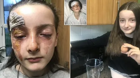 O fetiță de opt ani a suferit arsuri extrem de grave după ce i-a explodat un ou în față. A încercat cel mai periculos truc de gătit VIDEO