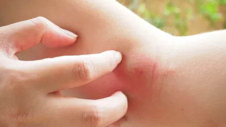 Leacuri pentru tratarea înţepăturilor de insecte. Scapă de durere cu ajutorul unor ingredientelor din bucătărie