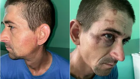 Bărbat bătut crunt în secția de poliție. Narcis Bobină are amprenta bocancului pe față