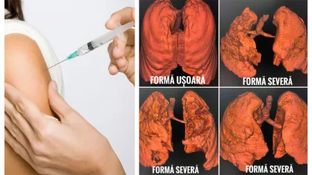 Campanie dură pentru vaccinarea anti-covid. Cum arată plămânii a patru pacienţi nevaccinaţi