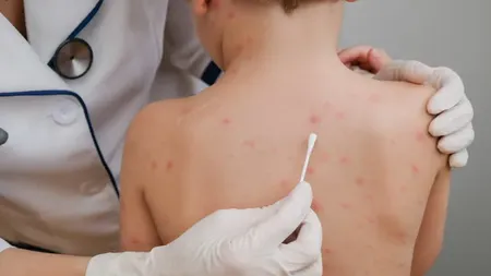 Nu dați sub nicio formă aceste medicamente copiilor care au varicelă! Avertisment important al medicilor
