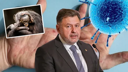 Rafila, despre variola maimuţei: Recomandarea aceasta de precauţie în alegerea partenerilor cred că trebuie să rămână în vigoare