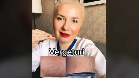 Cum poţi scăpa de vergeturi. Medicul Gabriela Bud a dezvăluit soluţia: 
