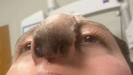 VIDEO O femeie este şocată de când a început să îi crească păr pe nas, în urma unei operaţii de reconstrucţie