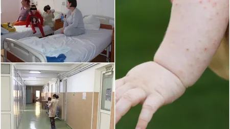 Primul deces de rujeolă din acest sezon în România. Victima, un bebeluș de 7 luni, a contractat virusul de la frățiorul lui care nu fusese vaccinat ROR