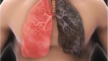 8 simptome mai puțin cunoscute ale cancerului pulmonar. Felul în care respiri poate fi un semnal de alarmă