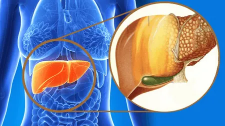 Boala ficatului gras. Medic: Dacă e ficat gras, foarte probabil că grăsimile sunt şi în altă parte. În România nu avem un stil de viaţă care să asigure o perioadă lungă de supravieţuire