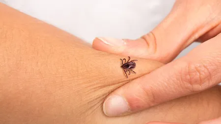Cum să previi boala Lyme. Modul prin care trebuie să îndepărtezi corect o căpușă