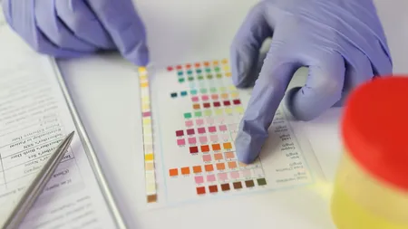 Impactul acidului ascorbic asupra rezultatelor testelor de urină 