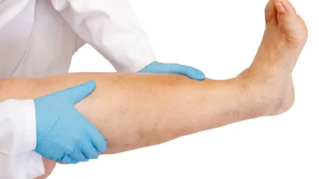 Ce înseamnă când ți se umflă un singur picior? Acest simptom poate ascunde afecțiuni grave. Mergi urgent la medic!
