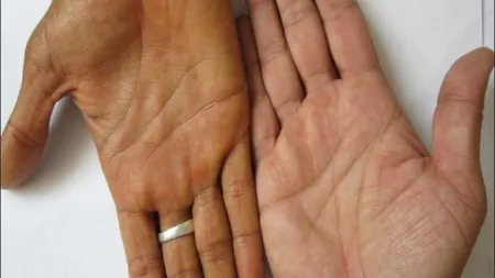 Ce probleme de sănătate poți avea în funcție de culoarea palmelor. Detaliile pe care mulți oameni le ignoră