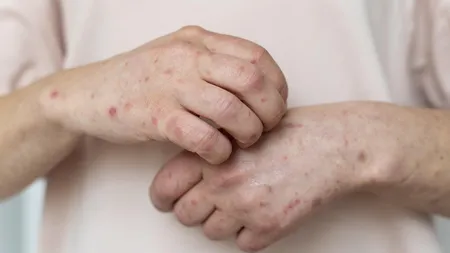 Ce simptome are lepra și cum se transmite. Ce trebuie să știi despre boala Hansen, cât de periculoasă este