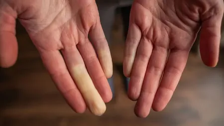 Boala semnalată de mâinile reci. Cum îți dai seama că nu e vorba despre o reacție la temperaturile scăzute