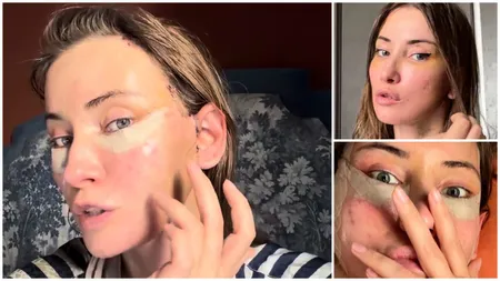 Iulia Albu recunoaște că a apelat la medicul estetician: „Nu vreau să arăt altfel, nu vreau buze mai mari, nici trăsături schimbate”