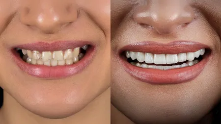 Before & after cu aparat dentar: ce se poate schimba atunci când tratamentul este planificat corect
