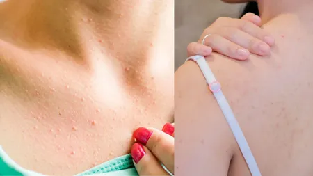 Adio, coșuri pe corp! Metoda care îți curăță pielea mai repede decât ai crede