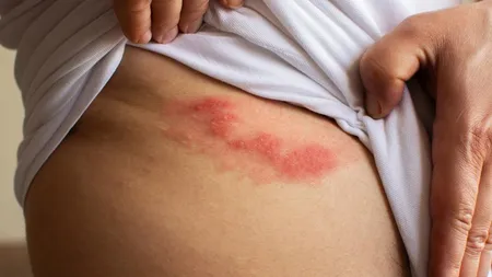 Factori care pot favoriza apariția herpesului zoster