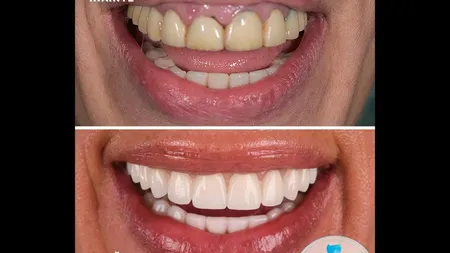Ce trebuie să știe pacienții despre implantul dentar Fast & Fixed la Dental Premier București?