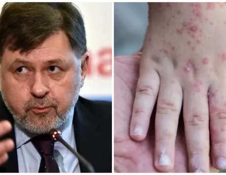 EXCLUSIV | Alexandru Rafila, avertisment despre infecţiile cu variola maimuţei. „România nu este pregătită. Nu există vaccinuri. Vaccinul variolic era produs în 1979”