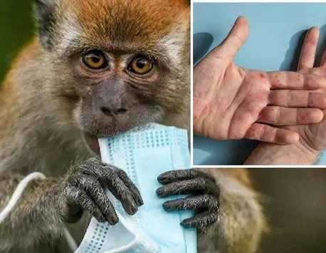 Variola maimuţei a evoluat într-o tulpină hiper-mutantă. Experţii susţin că virusul a suferit peste 50 mutaţii şi se răspândeşte mai repde