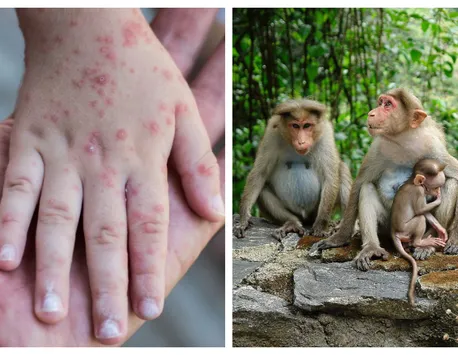 Român din Marea Britanie infectat cu variola maimuței. Atât el, cât și prietena lui sunt internați la spital