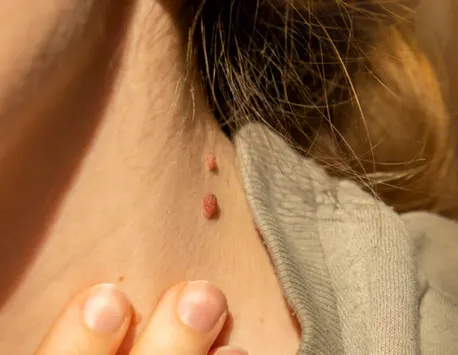 O femeie a învins melanomul după ce şi-a scos 100 de aluniţe