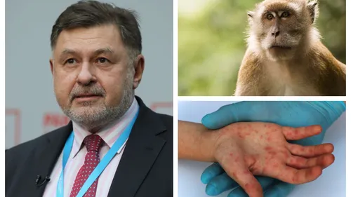 România cumpără 1000 de doze de vaccin împotriva variolei maimuţei. Anunţul de ultimă oră al ministrului Sănătăţii