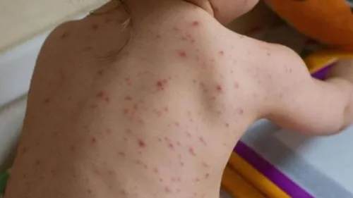 Focar de rujeolă într-o școală din București. Medic: ”Avem copii cu insuficiență respiratorie, avem complicații la nivelul digestiv, cu hepatite, pancreatite, dar cele mai de temut sunt cele neurologice”