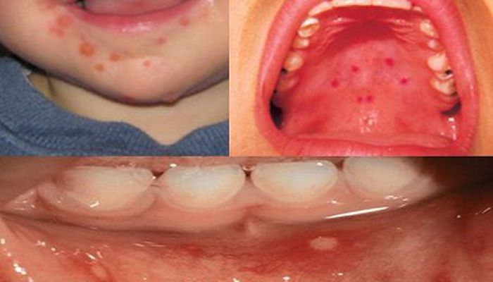 Boala GurÄ ManÄ Picior Tot Ce Trebuie SÄ Stii Despre AceastÄ BoalÄ A Copilariei AtenÅ£ie A Inceput Sezonul