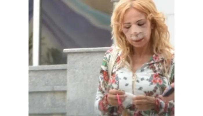Vedete Autohtone Care S Au Mutilat De La OperaÅ£ii Estetice Foto