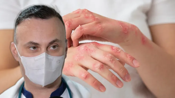 Medicul Adrian Marinescu trage un semnal de alarmă după confirmarea cazurilor de lepră din Cluj: „Oamenii, la un moment dat, făceau forme severe și ajungeau chiar la deces”