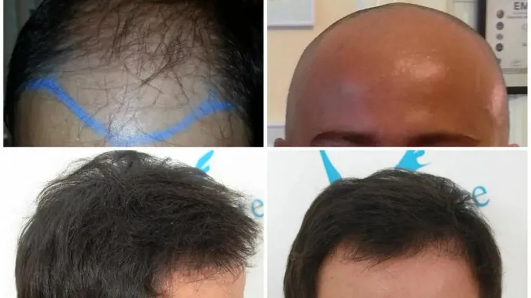 Clinica Dr. Felix Hair Implant te așteaptă cu servicii de transplant de păr Q-FUE