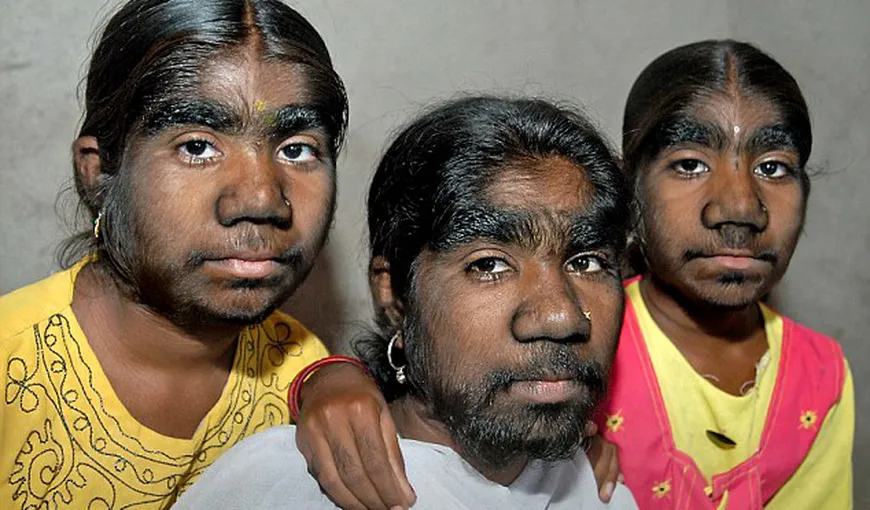 Trei surori din India suferă de „sindromul vârcolacului” VIDEO