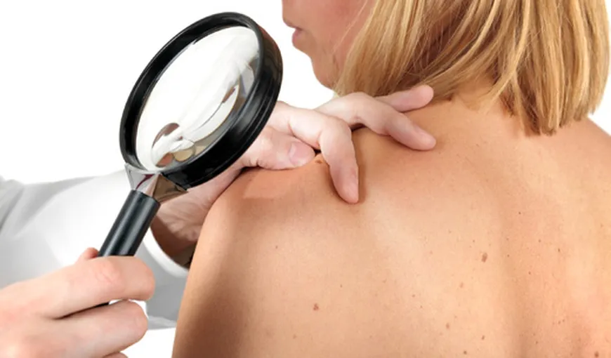 Testări gratuite pentru depistarea melanomului