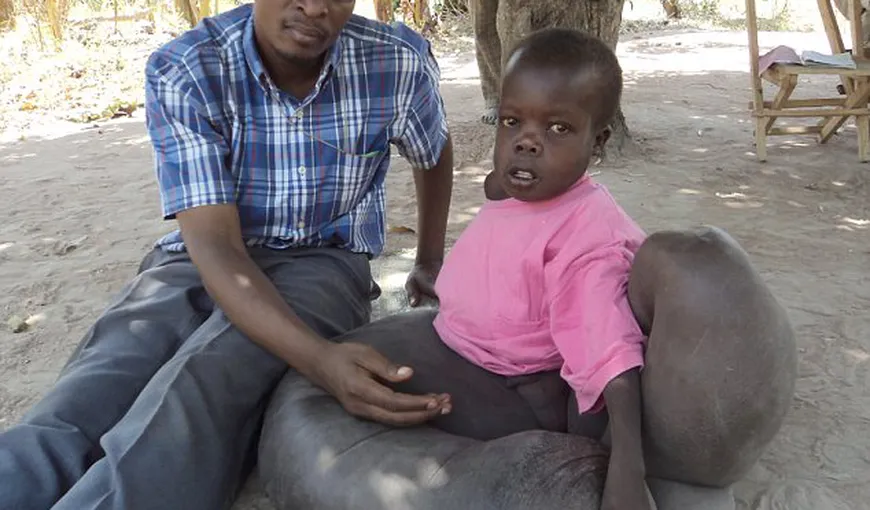 Un băiat din Uganda are o boală care i-a făcut picioarele „ca de elefant”